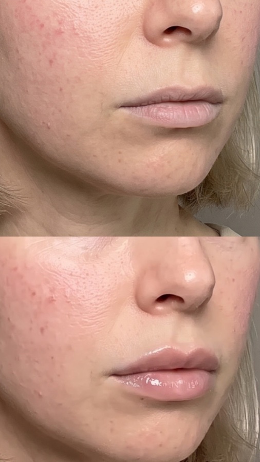 Avant / Après Lip Volume