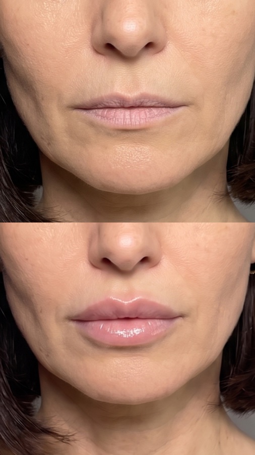 Avant / Après Lip Volume